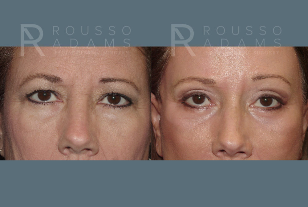 Blepharoplasty Before & After Gallery - Patient 146647264 - Image 1