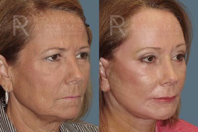 Blepharoplasty<span class=small>By Dr. Austin Adams</span> Before & After Gallery - Patient 146647264 - Image 2