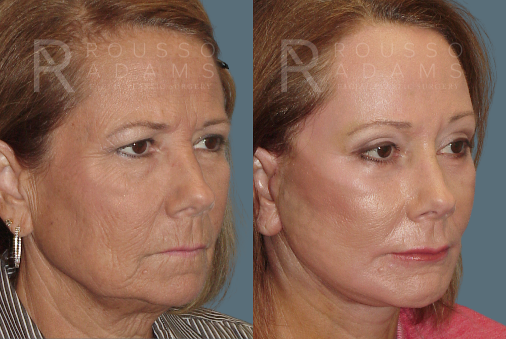 Blepharoplasty<span class=small>By Dr. Austin Adams</span> Before & After Gallery - Patient 146647264 - Image 2