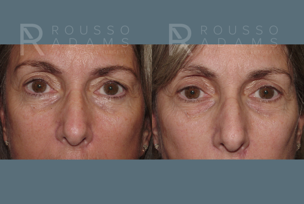 Blepharoplasty Before & After Gallery - Patient 146647265 - Image 1