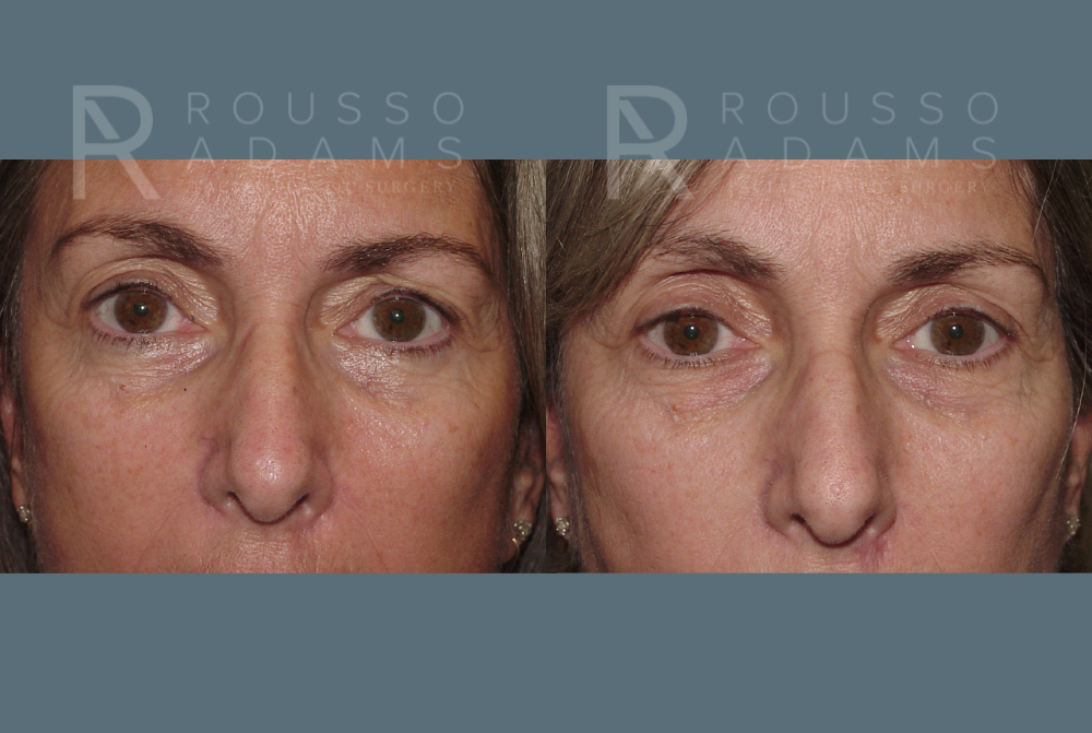 Blepharoplasty<span class=small>By Dr. Austin Adams</span> Before & After Gallery - Patient 146647265 - Image 1