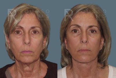 Blepharoplasty Before & After Gallery - Patient 146647265 - Image 2