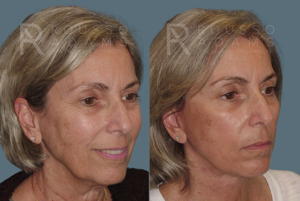 Blepharoplasty Before & After Gallery - Patient 146647265 - Image 3