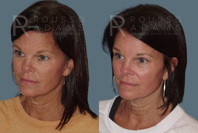 Blepharoplasty Before & After Gallery - Patient 146647266 - Image 2