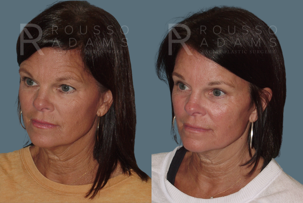 Blepharoplasty Before & After Gallery - Patient 146647266 - Image 2