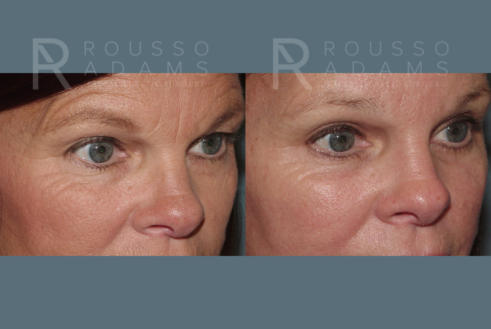 Blepharoplasty Before & After Gallery - Patient 146647266 - Image 1