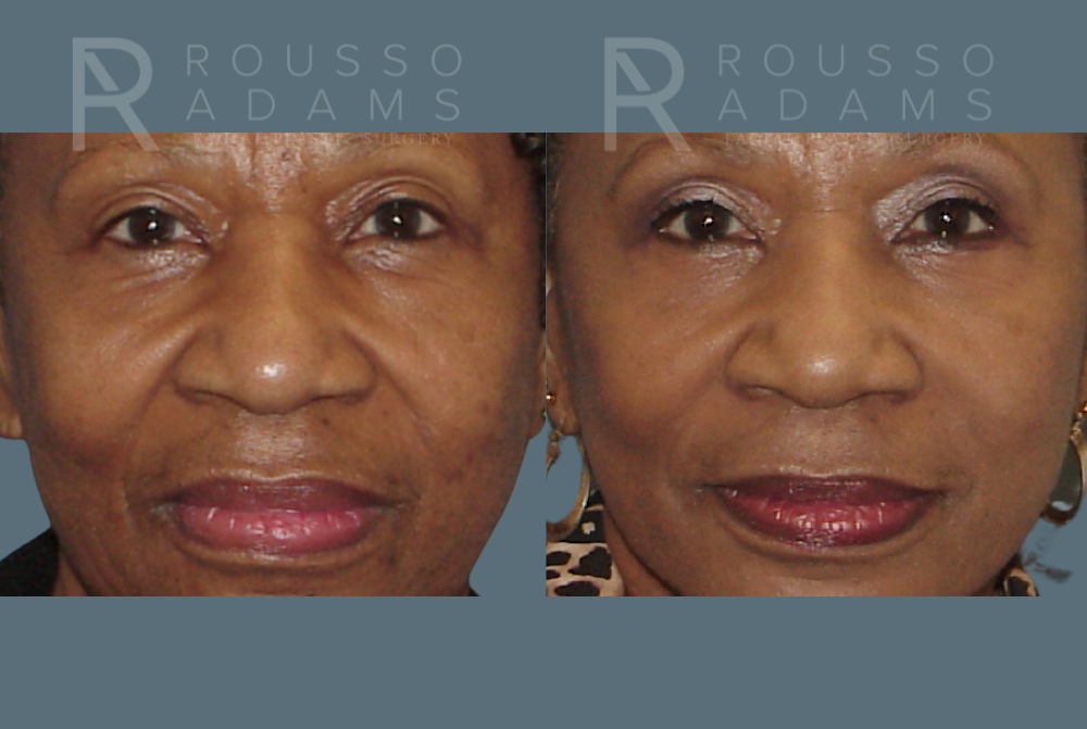 Blepharoplasty Before & After Gallery - Patient 146647267 - Image 1