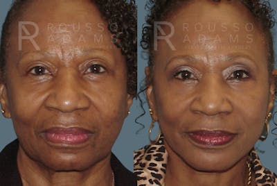 Blepharoplasty<span class=small>By Dr. Austin Adams</span> Before & After Gallery - Patient 146647267 - Image 2