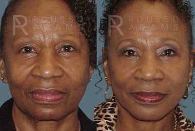 Blepharoplasty Before & After Gallery - Patient 146647267 - Image 2