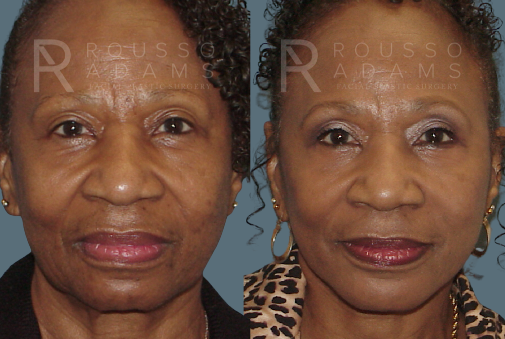 Blepharoplasty<span class=small>By Dr. Austin Adams</span> Before & After Gallery - Patient 146647267 - Image 2