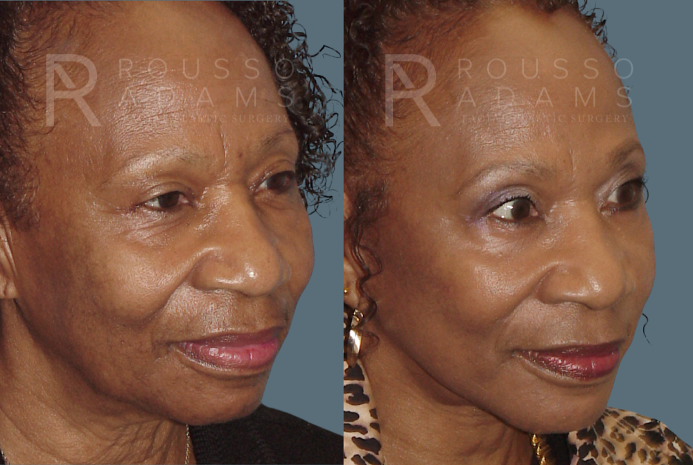 Blepharoplasty Before & After Gallery - Patient 146647267 - Image 3