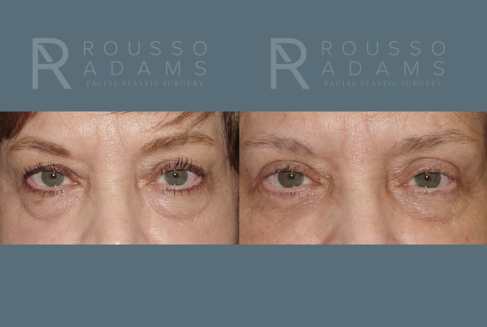 Blepharoplasty Before & After Gallery - Patient 146647268 - Image 1