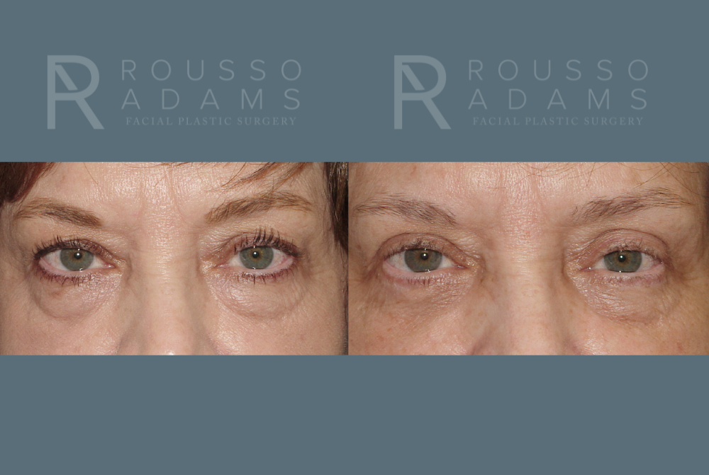 Blepharoplasty<span class=small>By Dr. Austin Adams</span> Before & After Gallery - Patient 146647268 - Image 1