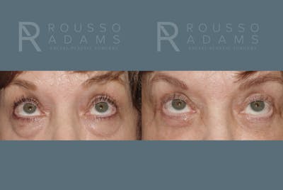 Blepharoplasty Before & After Gallery - Patient 146647268 - Image 2