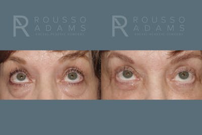 Blepharoplasty<span class=small>By Dr. Austin Adams</span> Before & After Gallery - Patient 146647268 - Image 2