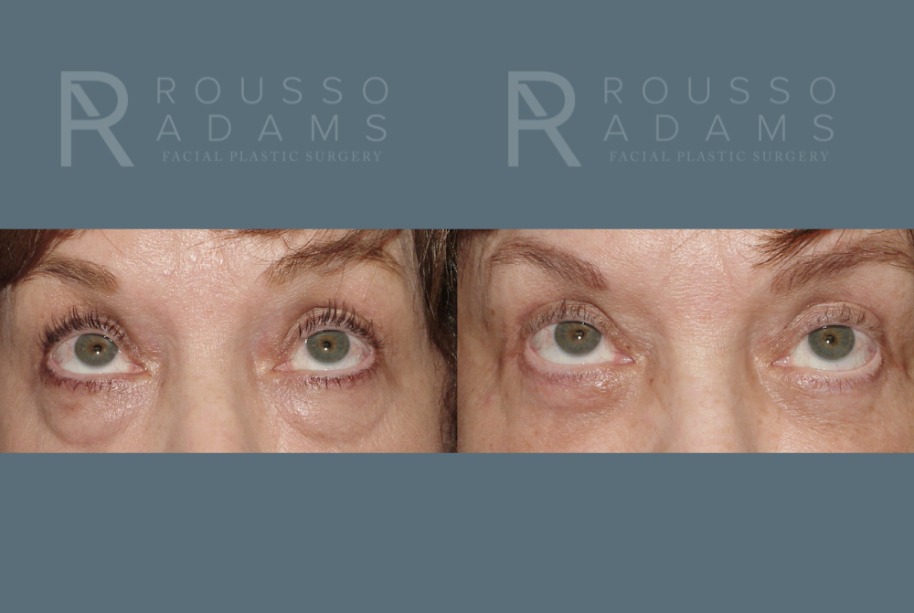 Blepharoplasty<span class=small>By Dr. Austin Adams</span> Before & After Gallery - Patient 146647268 - Image 2