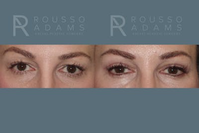 Blepharoplasty Before & After Gallery - Patient 146647269 - Image 1