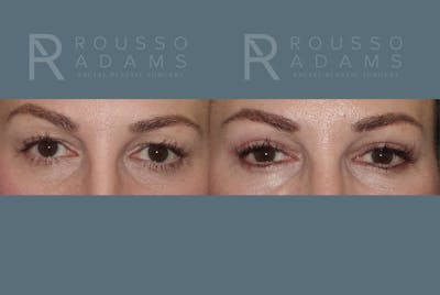 Blepharoplasty<span class=small>By Dr. Austin Adams</span> Before & After Gallery - Patient 146647269 - Image 1