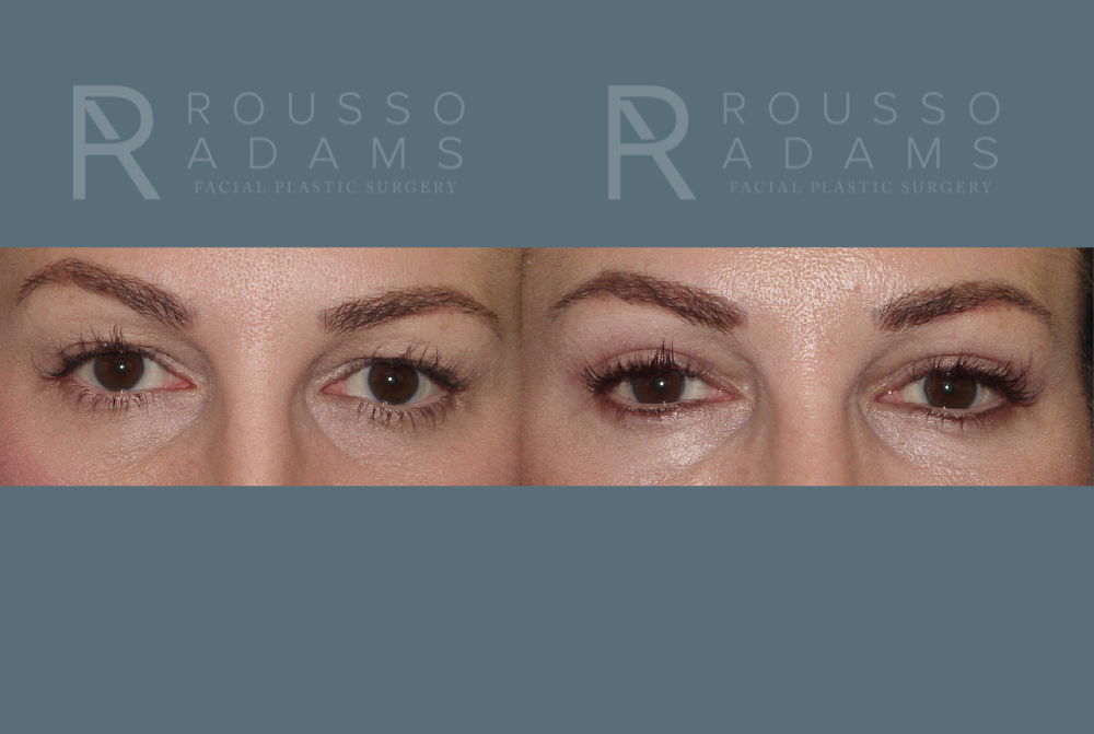 Blepharoplasty Before & After Gallery - Patient 146647269 - Image 1