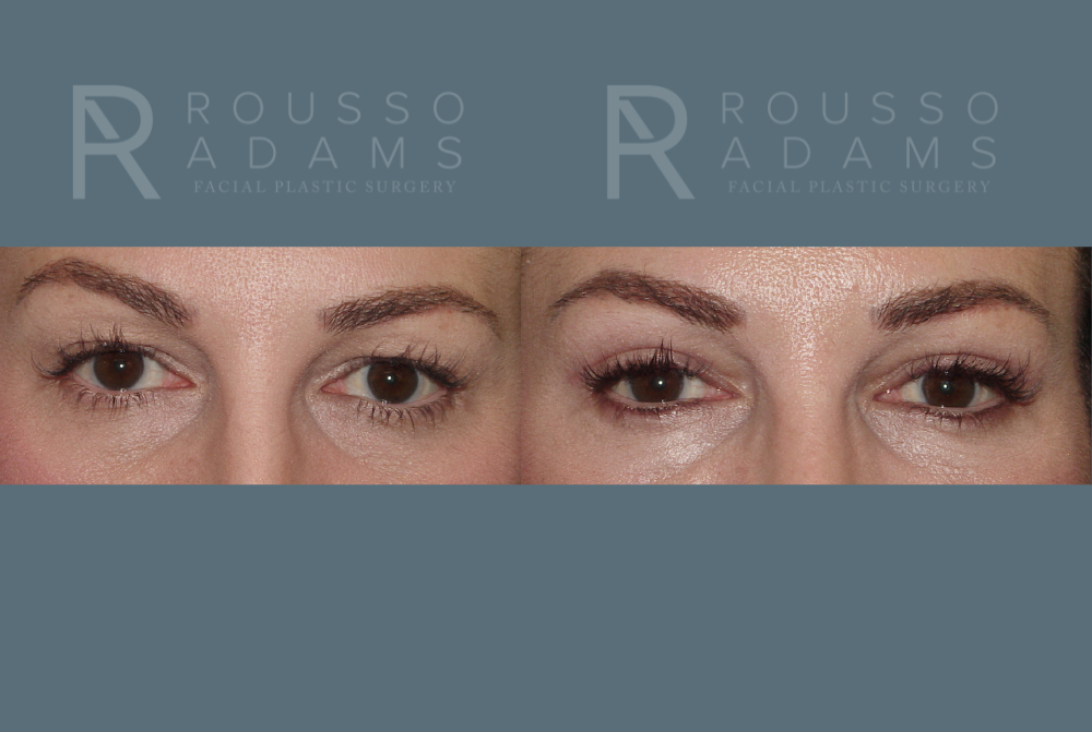 Blepharoplasty<span class=small>By Dr. Austin Adams</span> Before & After Gallery - Patient 146647269 - Image 1