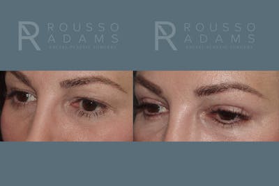 Blepharoplasty<span class=small>By Dr. Austin Adams</span> Before & After Gallery - Patient 146647269 - Image 2