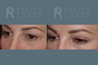 Blepharoplasty Before & After Gallery - Patient 146647269 - Image 2