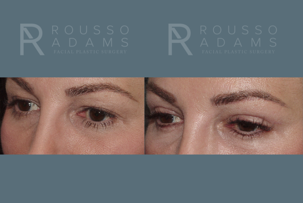 Blepharoplasty<span class=small>By Dr. Austin Adams</span> Before & After Gallery - Patient 146647269 - Image 2