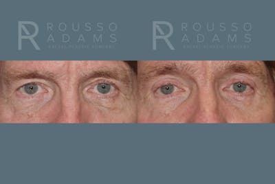 Blepharoplasty Before & After Gallery - Patient 146647270 - Image 1