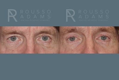 Blepharoplasty<span class=small>By Dr. Austin Adams</span> Before & After Gallery - Patient 146647270 - Image 1
