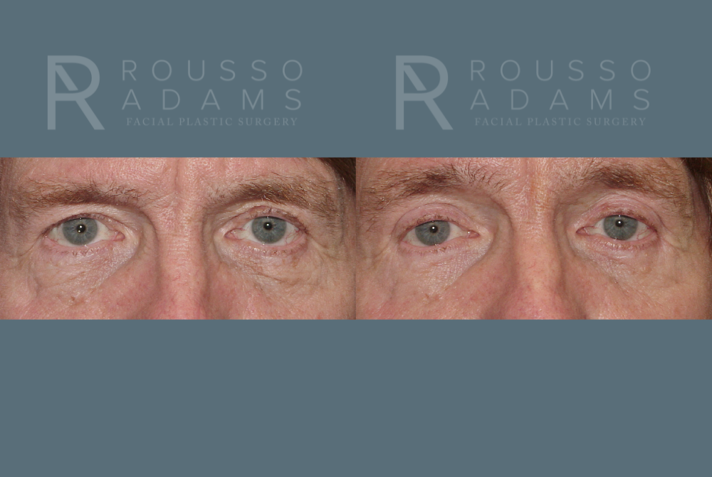 Blepharoplasty Before & After Gallery - Patient 146647270 - Image 1