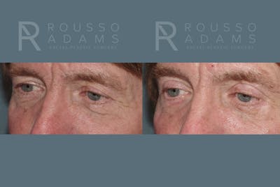Blepharoplasty<span class=small>By Dr. Austin Adams</span> Before & After Gallery - Patient 146647270 - Image 2