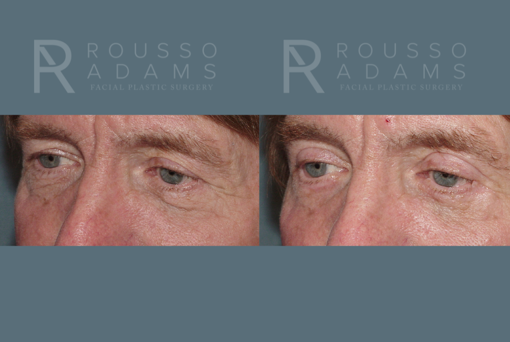 Blepharoplasty Before & After Gallery - Patient 146647270 - Image 2