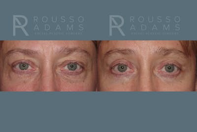 Blepharoplasty<span class=small>By Dr. Austin Adams</span> Before & After Gallery - Patient 146647271 - Image 1