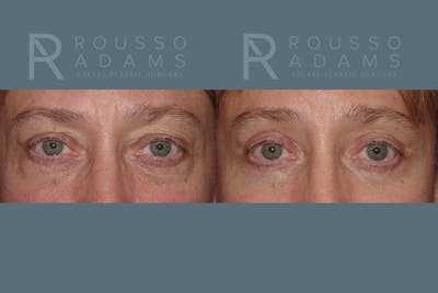 Blepharoplasty Before & After Gallery - Patient 146647271 - Image 1