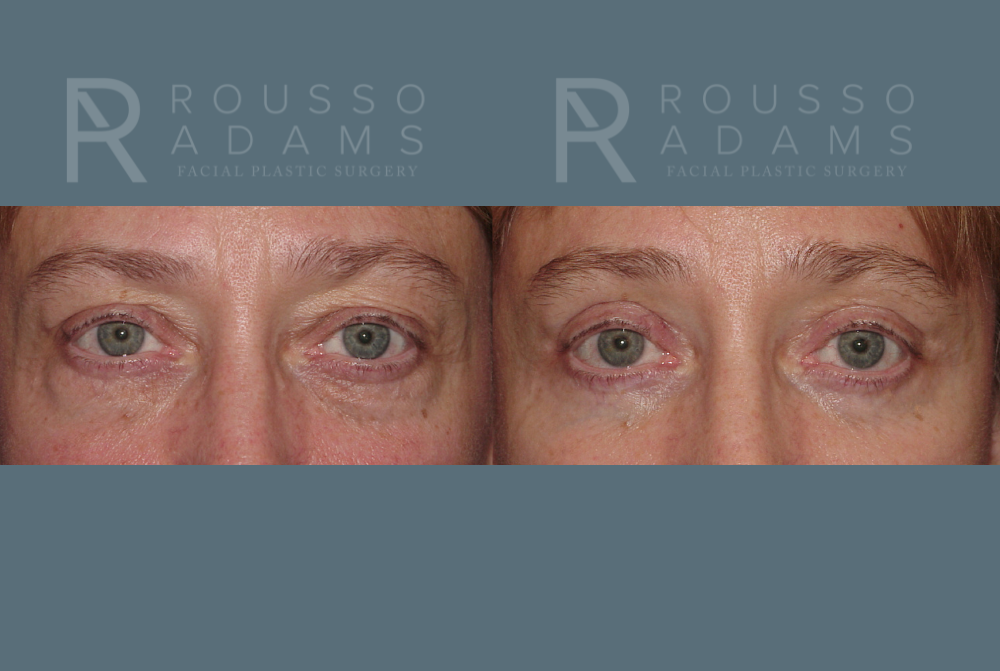 Blepharoplasty<span class=small>By Dr. Austin Adams</span> Before & After Gallery - Patient 146647271 - Image 1