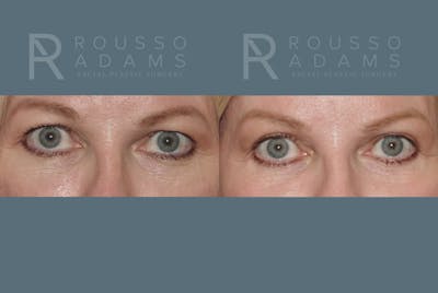 Blepharoplasty<span class=small>By Dr. Austin Adams</span> Before & After Gallery - Patient 146647272 - Image 1