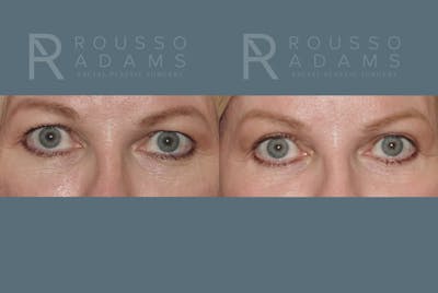 Blepharoplasty Before & After Gallery - Patient 146647272 - Image 1