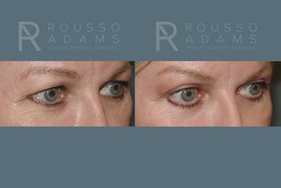 Blepharoplasty<span class=small>By Dr. Austin Adams</span> Before & After Gallery - Patient 146647272 - Image 2