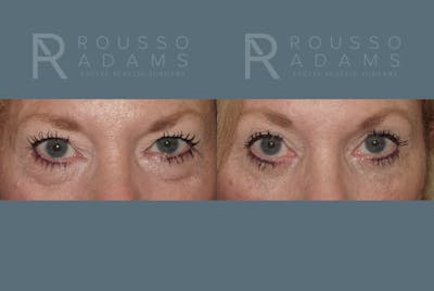 Blepharoplasty Before & After Gallery - Patient 146647273 - Image 1