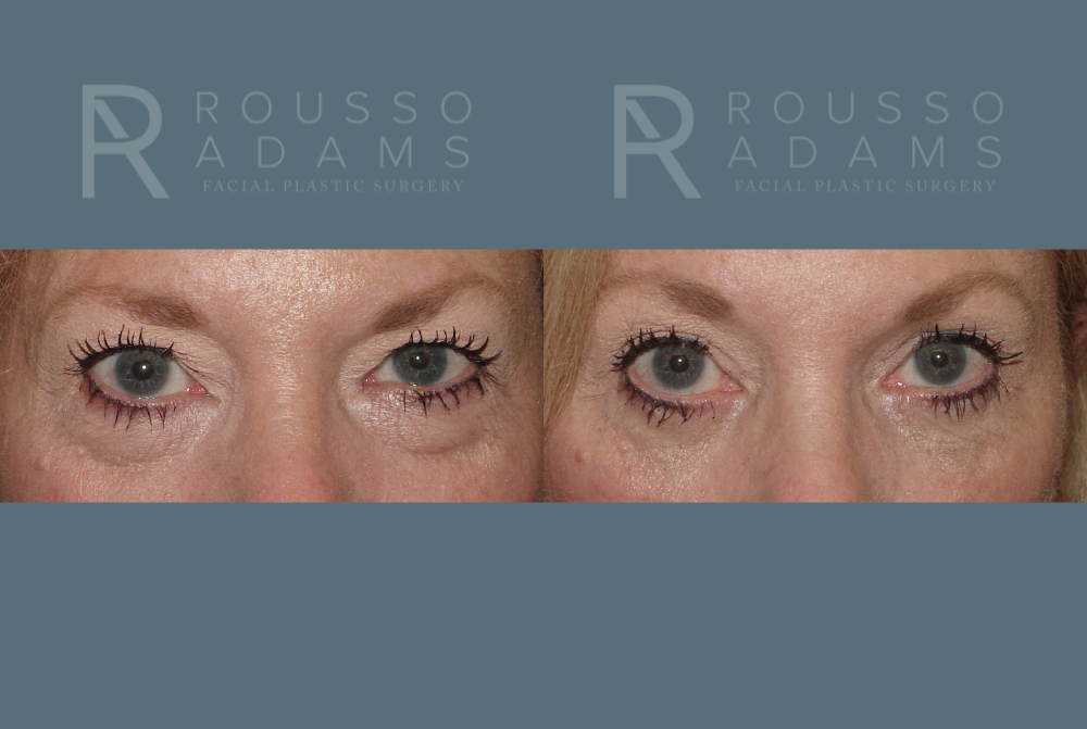 Blepharoplasty<span class=small>By Dr. Austin Adams</span> Before & After Gallery - Patient 146647273 - Image 1