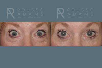 Blepharoplasty<span class=small>By Dr. Austin Adams</span> Before & After Gallery - Patient 146647273 - Image 2