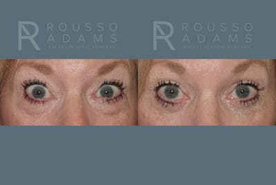 Blepharoplasty Before & After Gallery - Patient 146647273 - Image 2