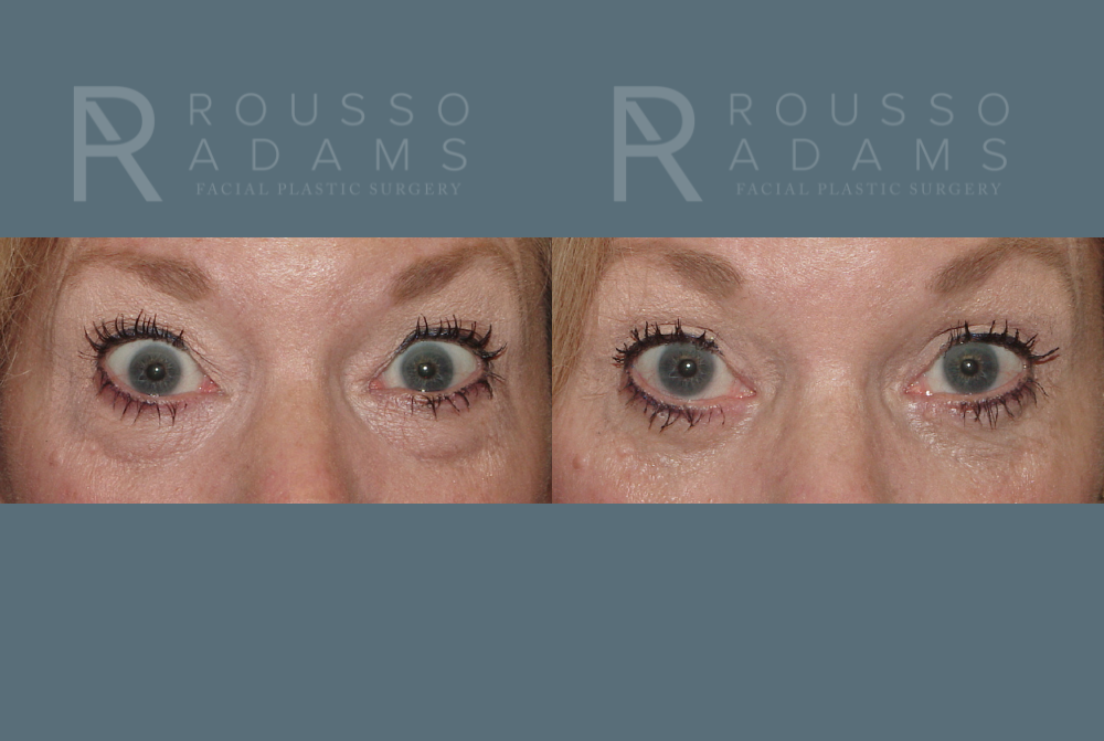 Blepharoplasty<span class=small>By Dr. Austin Adams</span> Before & After Gallery - Patient 146647273 - Image 2