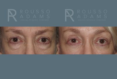 Blepharoplasty<span class=small>By Dr. Austin Adams</span> Before & After Gallery - Patient 146647274 - Image 1