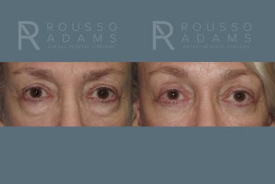 Blepharoplasty Before & After Gallery - Patient 146647274 - Image 1