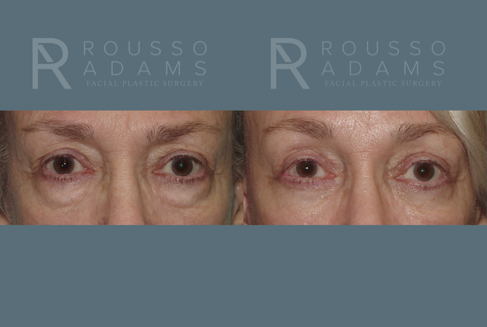Blepharoplasty<span class=small>By Dr. Austin Adams</span> Before & After Gallery - Patient 146647274 - Image 1