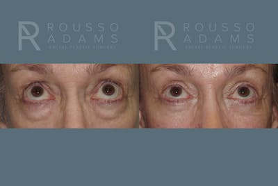 Blepharoplasty Before & After Gallery - Patient 146647274 - Image 2