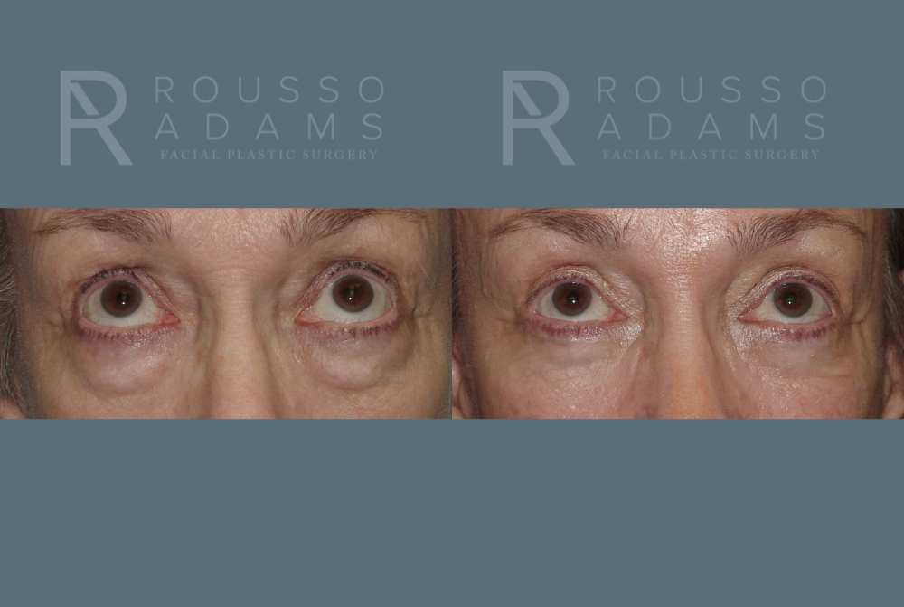 Blepharoplasty<span class=small>By Dr. Austin Adams</span> Before & After Gallery - Patient 146647274 - Image 2