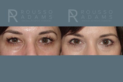 Blepharoplasty Before & After Gallery - Patient 146647275 - Image 1