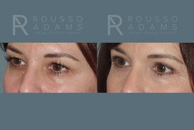 Blepharoplasty<span class=small>By Dr. Austin Adams</span> Before & After Gallery - Patient 146647275 - Image 2